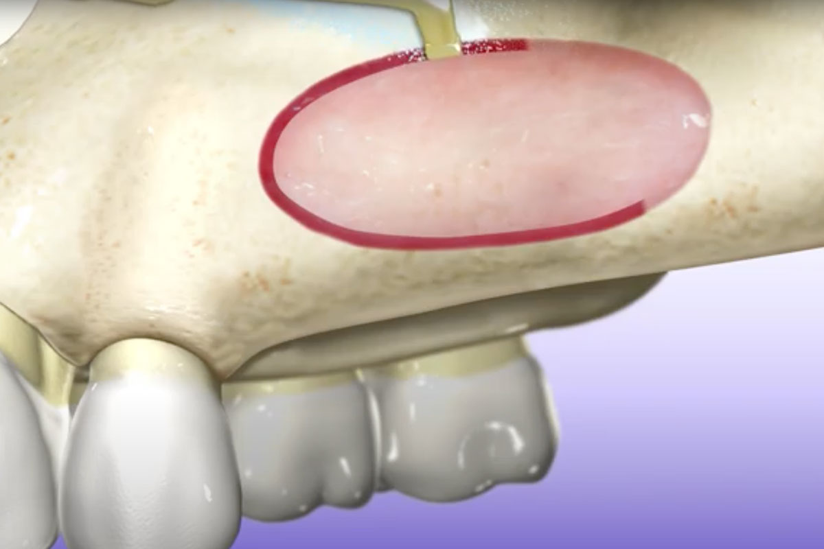 PIEZOSURGERY Tecnica Sinus Lift Per Via Laterale Discover Mectron