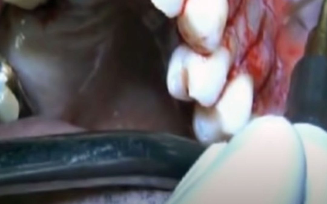 PIEZOSURGERY® – Corticotomy in orthodontic surgery by Dr. Marco Finotti