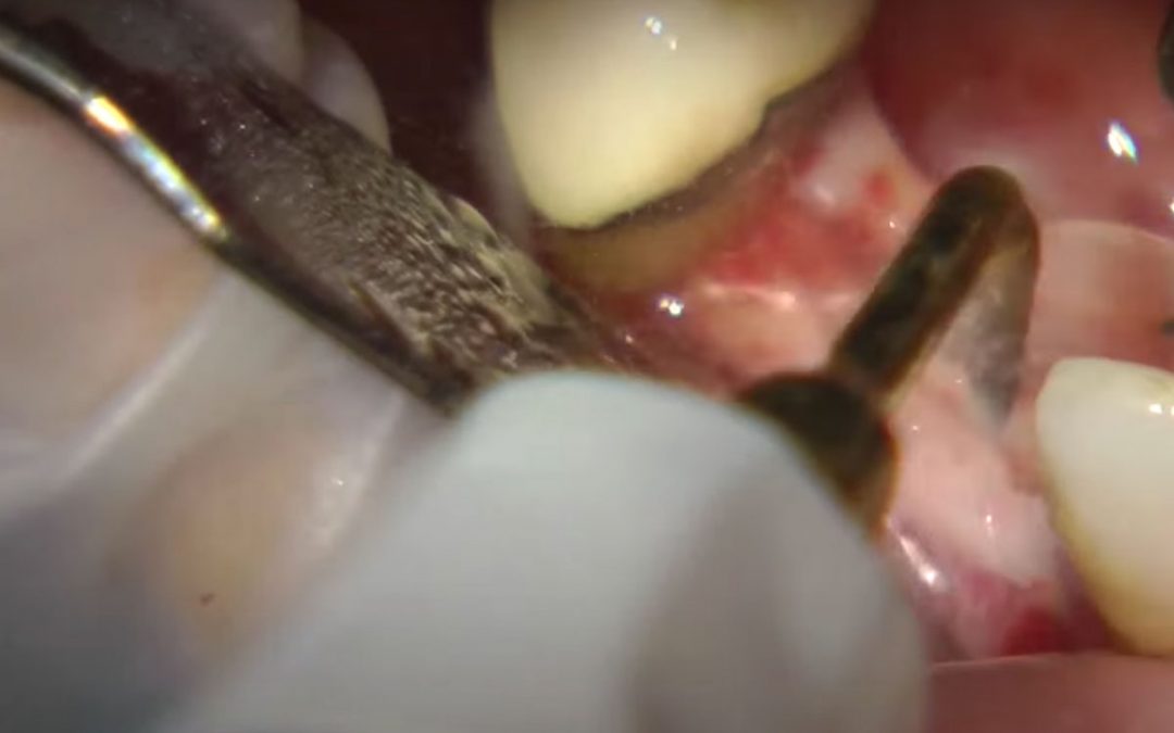 PIEZOSURGERY® – Ridge Expansion Technique by Dr. Rosario Sentineri