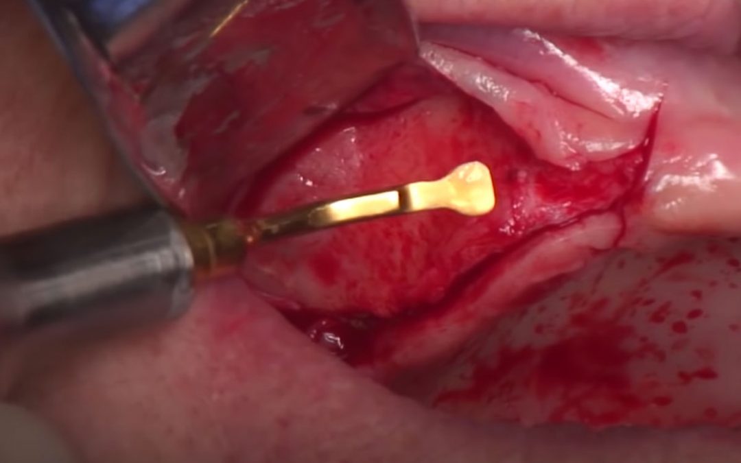 Scopri l’innovativa tecnica PIEZOSURGERY® di rialzo del seno per via laterale