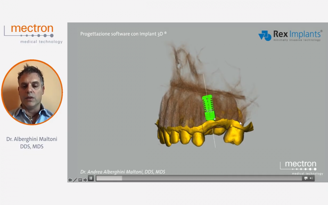 REX PiezoImplant nell’era dell’implantologia digitale