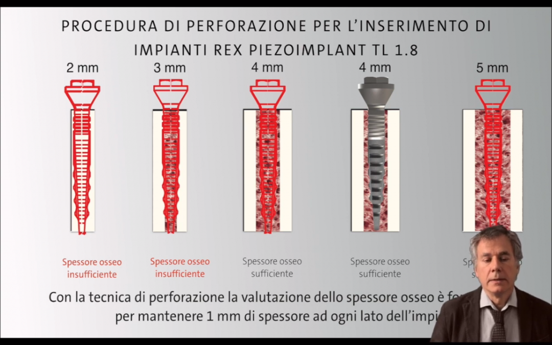 Rexpander®: evoluzione della preparazione del sito implantare