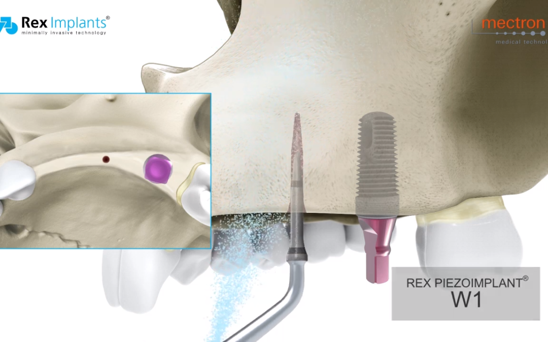 Come preservare e aumentare il volume osseo attorno all’impianto con l’innovativa tecnica rexpander®