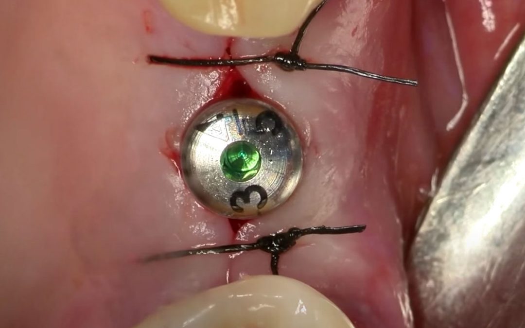 Scopri la tecnica di preparazione ultrasonica del sito implantare con PIEZOSURGERY®