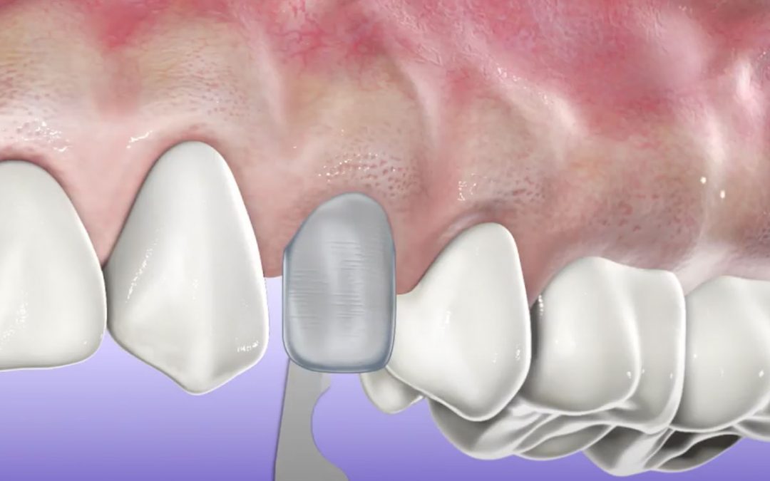 PIEZOSURGERY® – Estrazione e preparazione endoalveolare del sito implantare