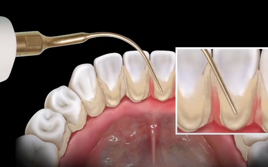 Come rimuovere il tartaro sopragengivale in maniera ultra delicata con la tecnologia Mectron