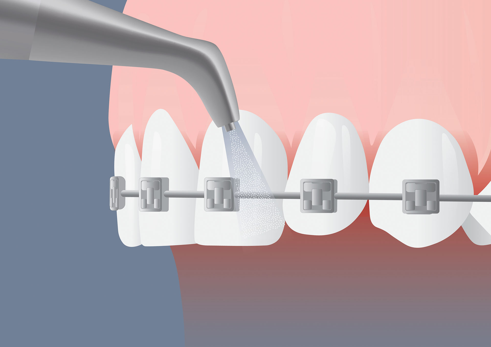 Trattamento brackets ortodontici