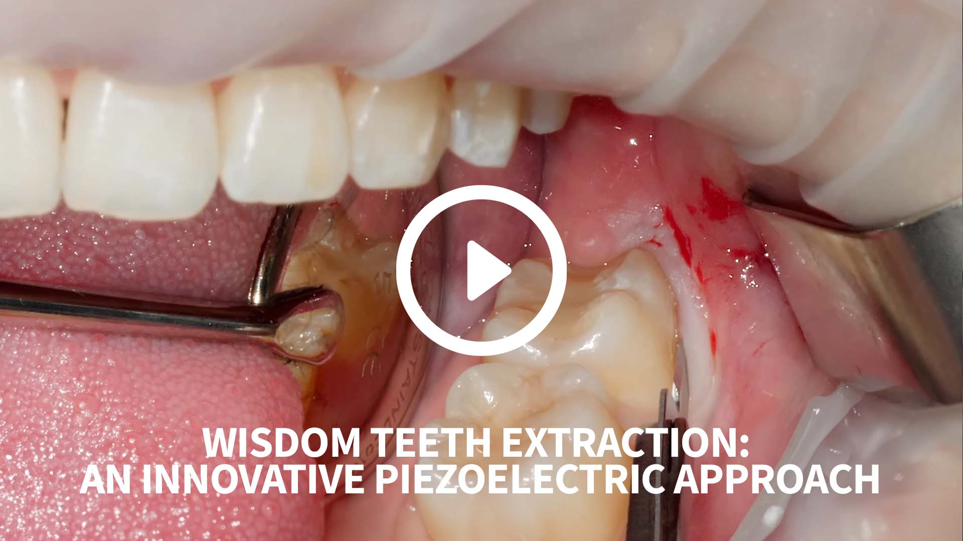Wisdom teeth extraction - an innovative piezoelectric approach
