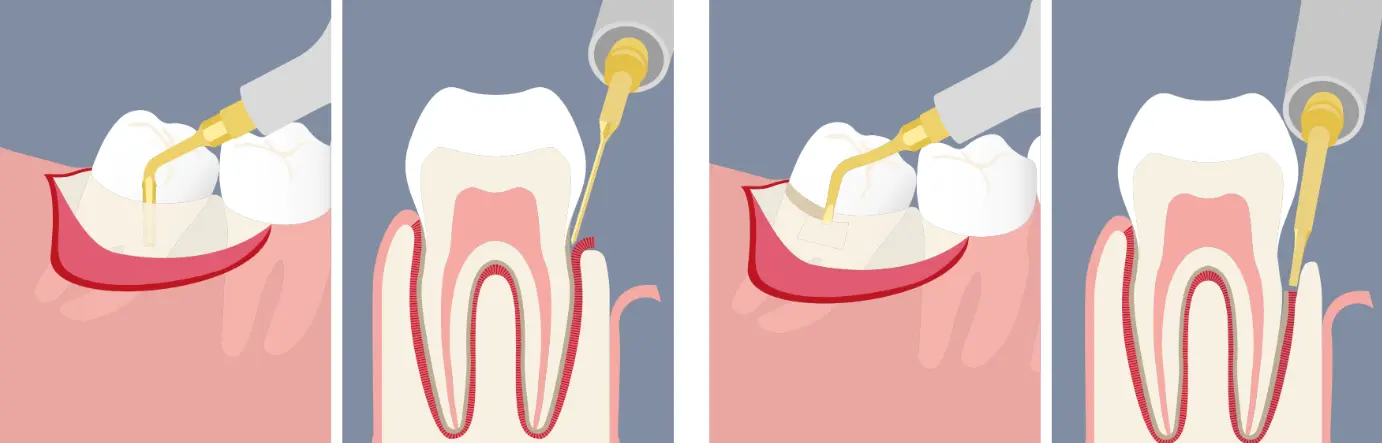 Techniques innovantes pour l’extraction des dents de sagesse - Motta - Mectron