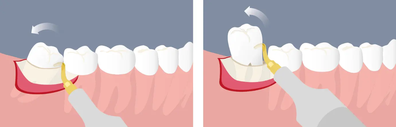 Techniques innovantes pour l’extraction des dents de sagesse - Motta - Mectron