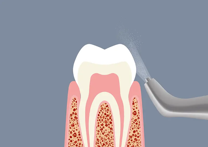 Trattamento brackets ortodontici