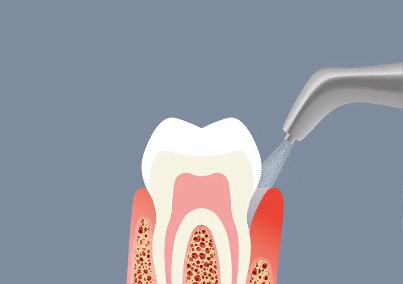 Lucidatura pre-sbiancamento dentale